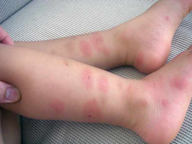 Проявление аллергии у ребенка