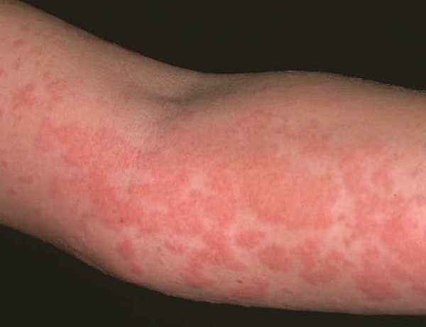 Проявления аллергии у взрослого