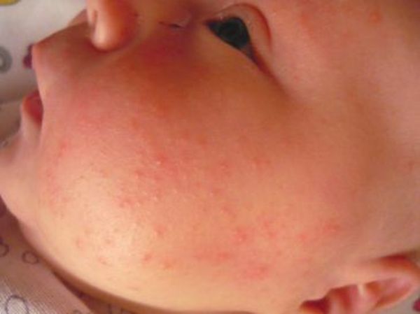 Аллергия у ребенка протекает тяжелее